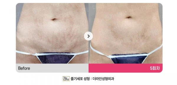 Stem Cell Stretch Mark Treatment before-and-after photo, before surgery - TheLINE Plastic Surgery