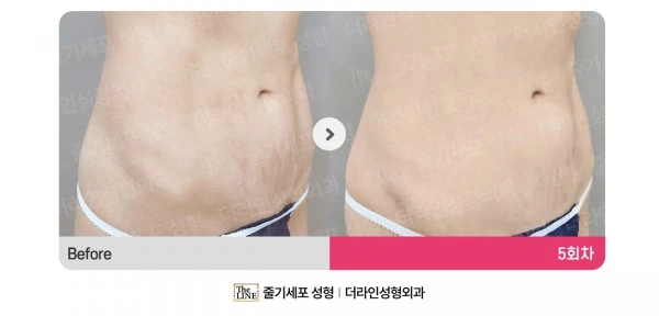 Stem Cell Stretch Mark Treatment before-and-after photo, before surgery - TheLINE Plastic Surgery