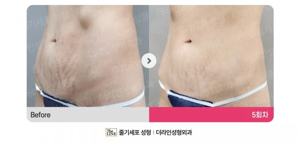Stem Cell Stretch Mark Treatment before-and-after photo, before surgery - TheLINE Plastic Surgery