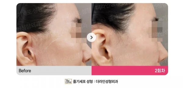 Stem Cell Scar Treatment before-and-after photo, before surgery - TheLINE Plastic Surgery