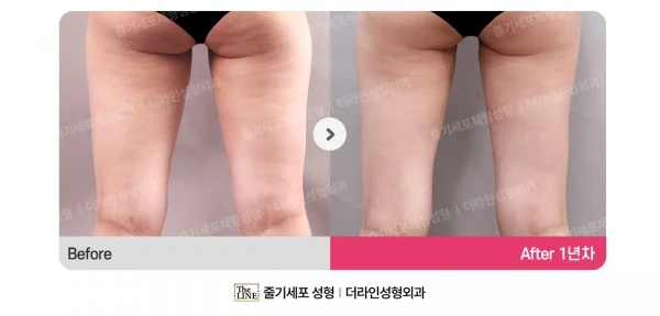Stem Cell Cellulite Treatment before-and-after photo, before surgery - TheLINE Plastic Surgery
