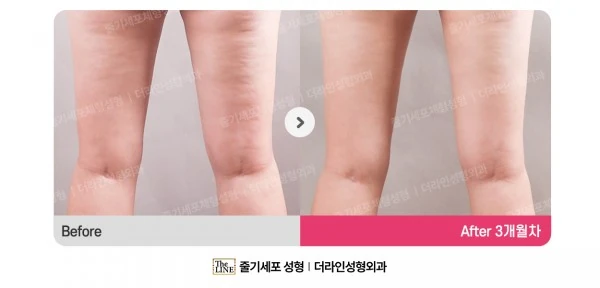 Stem Cell Cellulite Treatment before-and-after photo, before surgery - TheLINE Plastic Surgery