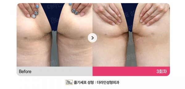 Stem Cell Cellulite Treatment before-and-after photo, before surgery - TheLINE Plastic Surgery
