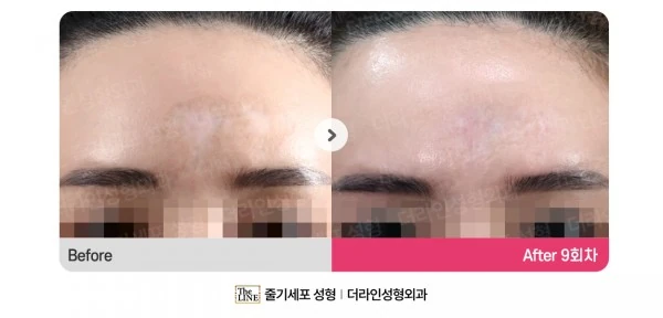 Stem Cell Scar Treatment before-and-after photo, before surgery - TheLINE Plastic Surgery