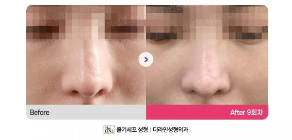 Stem Cell Scar Treatment before-and-after photo, before surgery - TheLINE Plastic Surgery