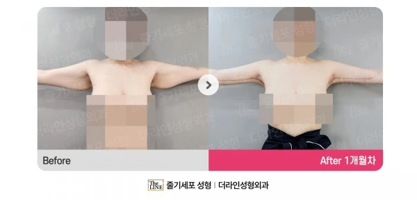 Arm Lift before-and-after photo, before surgery - TheLINE Plastic Surgery