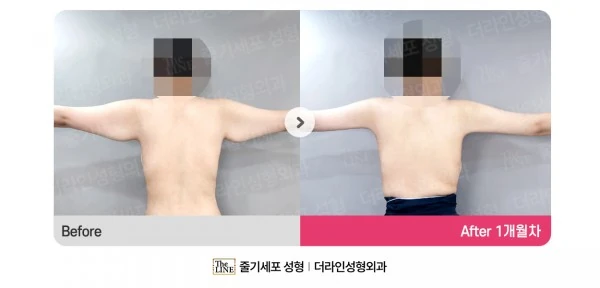 Arm Lift before-and-after photo, before surgery - TheLINE Plastic Surgery