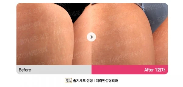 Stem Cell Stretch Mark Treatment before-and-after photo, before surgery - TheLINE Plastic Surgery