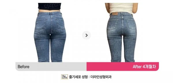Waist to Saddlebags before-and-after photo, before surgery - TheLINE Plastic Surgery