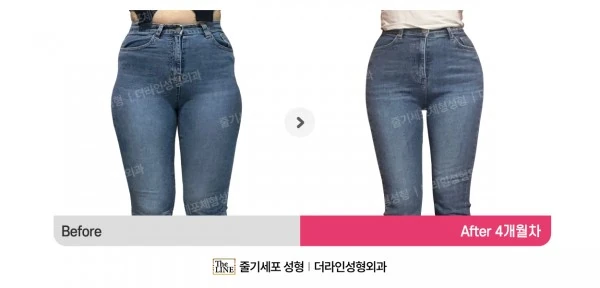 Waist to Saddlebags before-and-after photo, before surgery - TheLINE Plastic Surgery