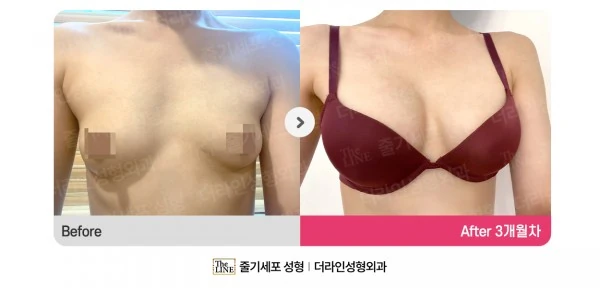 Breast Augmentation + Breast Fat Graftin before-and-after photo, before surgery - TheLINE Plastic Surgery