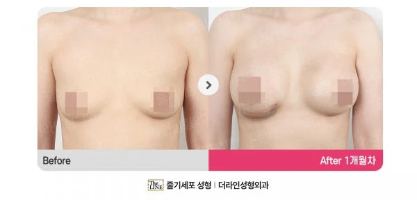 Breast Augmentation + Breast Fat Graftin before-and-after photo, before surgery - TheLINE Plastic Surgery
