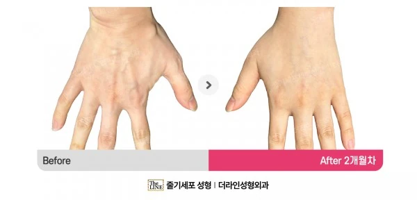 Hand Fat Grafting before-and-after photo, before surgery - TheLINE Plastic Surgery