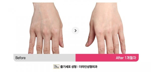 Hand Fat Grafting before-and-after photo, before surgery - TheLINE Plastic Surgery