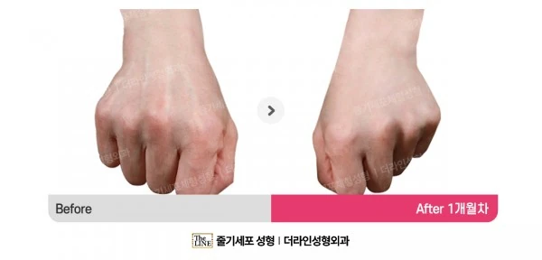 Hand Fat Grafting before-and-after photo, before surgery - TheLINE Plastic Surgery