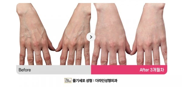 Hand Fat Grafting before-and-after photo, before surgery - TheLINE Plastic Surgery