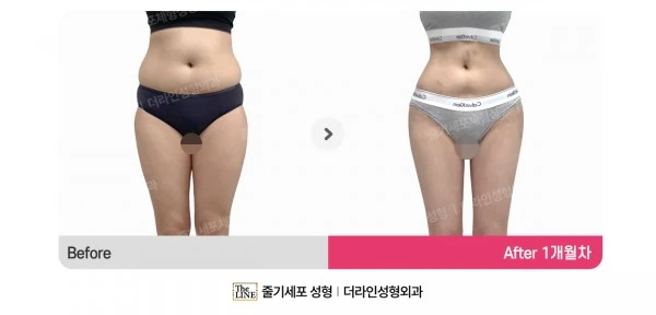 Waist to Saddlebags, before and after 1 month at Seoul Lipo Center