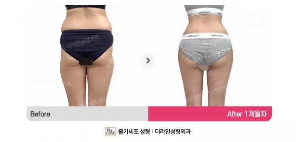 Waist to Saddlebags before-and-after photo, before surgery - TheLINE Plastic Surgery