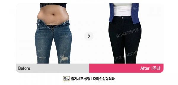 Waist to Saddlebags, before and after 1 week at Seoul Lipo Center