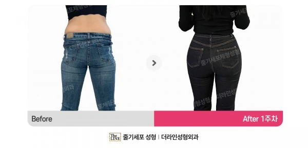 Waist to Saddlebags before-and-after photo, before surgery - TheLINE Plastic Surgery