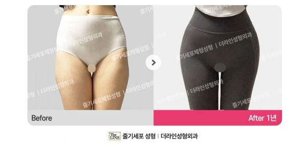 Waist to Saddlebags, before and after 1 year at Seoul Lipo Center