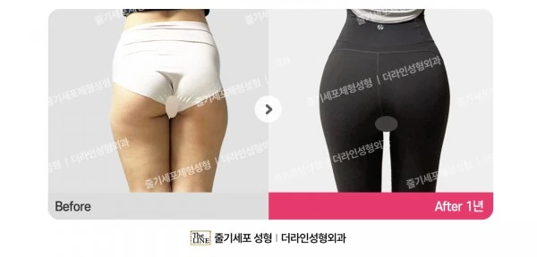 Waist to Saddlebags before-and-after photo, before surgery - TheLINE Plastic Surgery