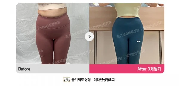 Waist to Saddlebags, before and after 3 months at Seoul Lipo Center