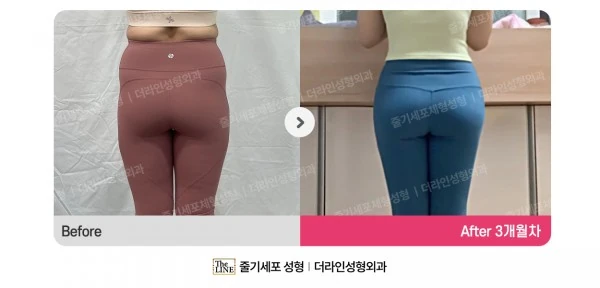 Waist to Saddlebags before-and-after photo, before surgery - TheLINE Plastic Surgery