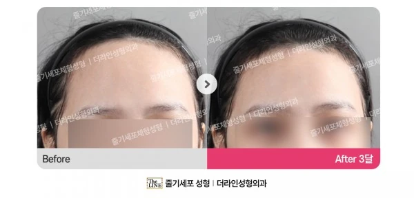 Forehead Reduction before-and-after photo, before surgery - TheLINE Plastic Surgery
