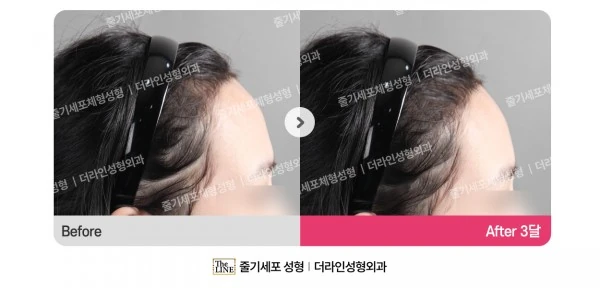 Forehead Reduction before-and-after photo, before surgery - TheLINE Plastic Surgery