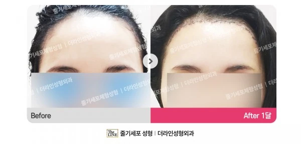 Forehead Reduction before-and-after photo, before surgery - TheLINE Plastic Surgery