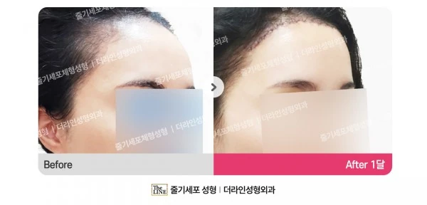 Forehead Reduction before-and-after photo, before surgery - TheLINE Plastic Surgery