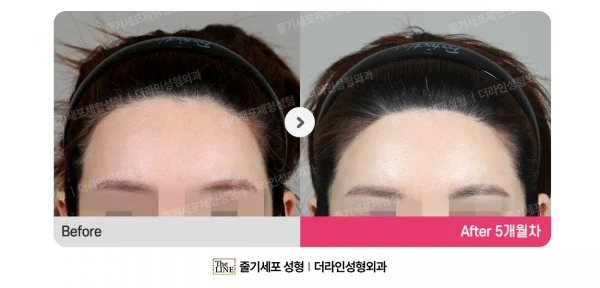 Forehead Reduction before-and-after photo, before surgery - TheLINE Plastic Surgery