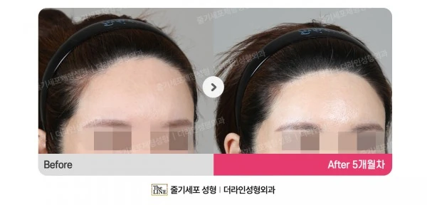 Forehead Reduction before-and-after photo, before surgery - TheLINE Plastic Surgery