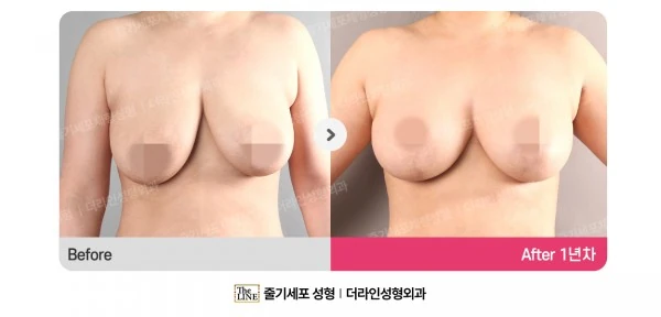 Breast Reduction + Breast Lift before-and-after photo, before surgery - TheLINE Plastic Surgery