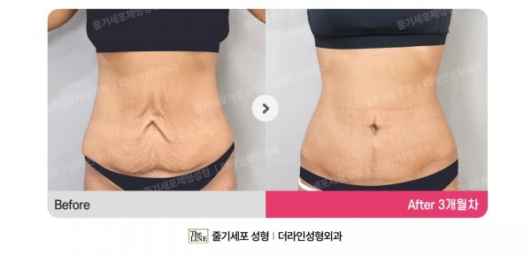 Abdominal Lift before-and-after photo, before surgery - TheLINE Plastic Surgery