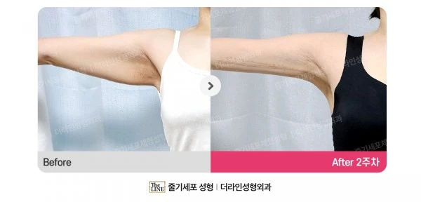 Arm Lift before-and-after photo, before surgery - TheLINE Plastic Surgery