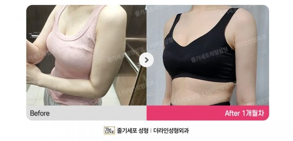 Arm Lift before-and-after photo, before surgery - TheLINE Plastic Surgery