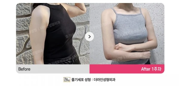 Arm Lift before-and-after photo, before surgery - TheLINE Plastic Surgery