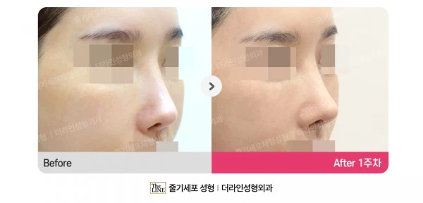 Rhinoplasty Revision before-and-after photo, before surgery - TheLINE Plastic Surgery