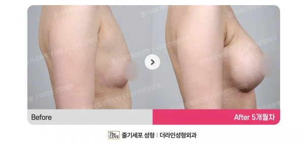 Breast Implants before-and-after photo, before surgery - TheLINE Plastic Surgery