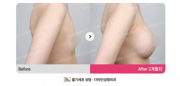 Breast Implants before-and-after photo, before surgery - TheLINE Plastic Surgery