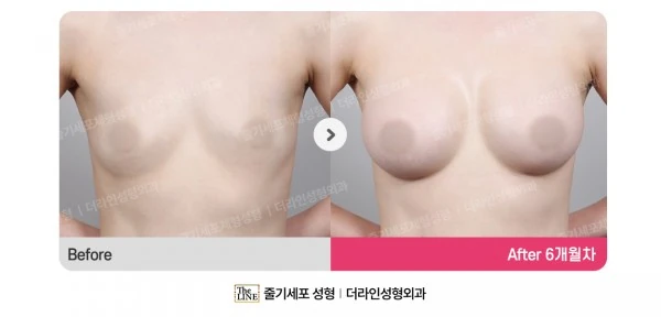 Breast Implants before-and-after photo, before surgery - TheLINE Plastic Surgery