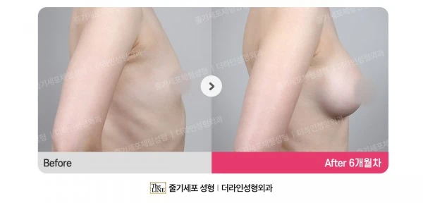Breast Implants before-and-after photo, before surgery - TheLINE Plastic Surgery