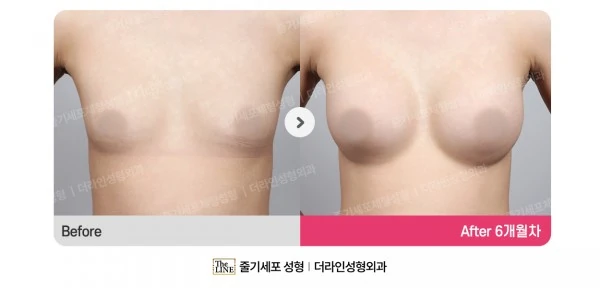 Breast Implants before-and-after photo, before surgery - TheLINE Plastic Surgery
