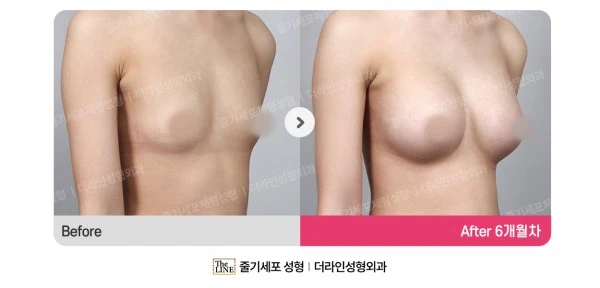 Breast Implants before-and-after photo, before surgery - TheLINE Plastic Surgery