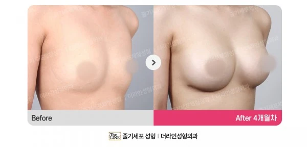 Breast Implants before-and-after photo, before surgery - TheLINE Plastic Surgery
