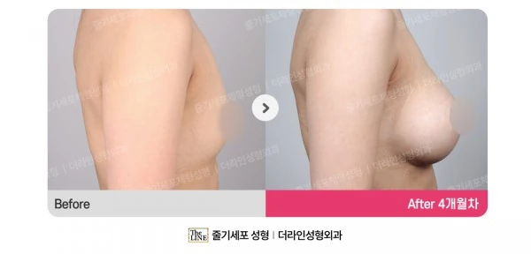 Breast Implants before-and-after photo, before surgery - TheLINE Plastic Surgery