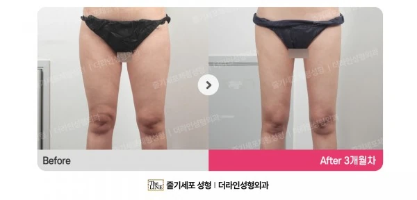 Thigh Liposuction, before and after 3 months at Seoul Lipo Center