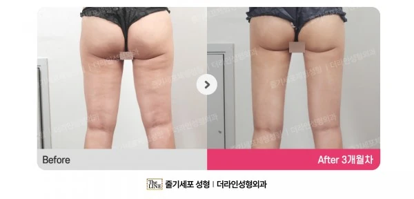 Thigh Liposuction before-and-after photo, before surgery - TheLINE Plastic Surgery